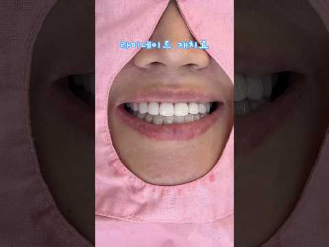 <strong>라미네이트</strong> 재치료 #dentist #smiledesigndental #dentistry #veneers