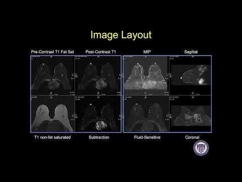 Breast MRI