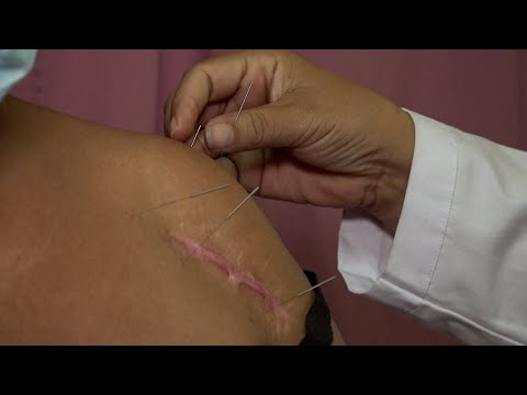 Pacientes crónicos reciben terapia de acupuntura