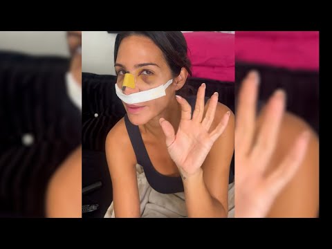 Tamara Gorro enseña como ha quedado su nariz tras su operación de rinoplastia