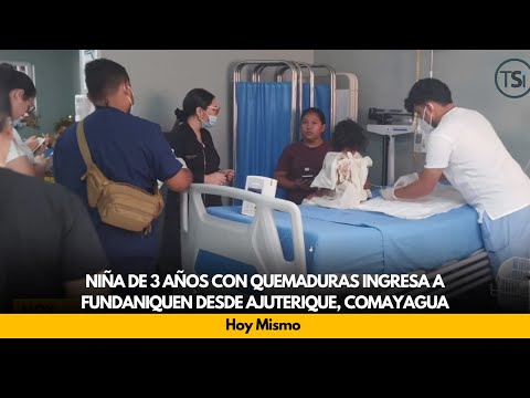 Niña de 3 años con quemaduras Ingresa a FUNDANIQUEN desde Ajuterique, Comayagua