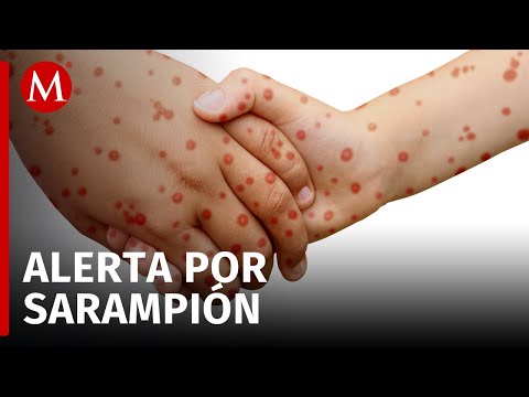 ¡Alerta de salud! Casos importantes de sarampión detectados en el país