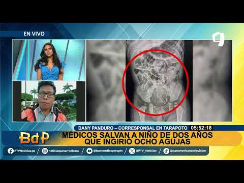 Tarapoto: Médicos salvan a niño de dos años que ingirió ocho agujas