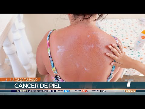 Cuida tu Salud: El cáncer de piel