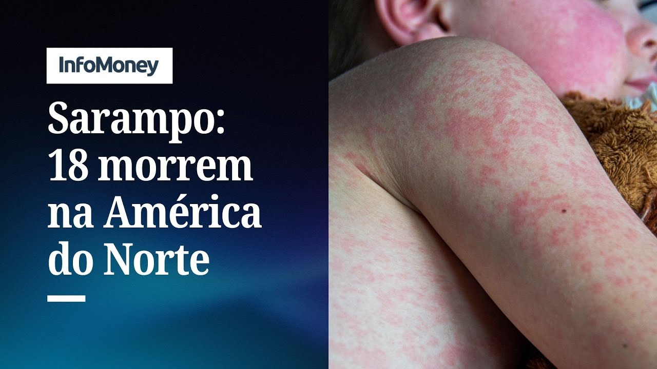 Surto de sarampo avança na América do Norte 18 pessoas já morreram | InfoMoney News