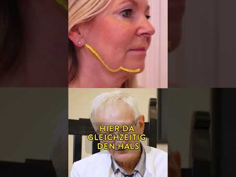 Facelift bei 51-jähriger Patientin Vorher & 5 Wochen nach OP! #facelift #plastischechirurgie