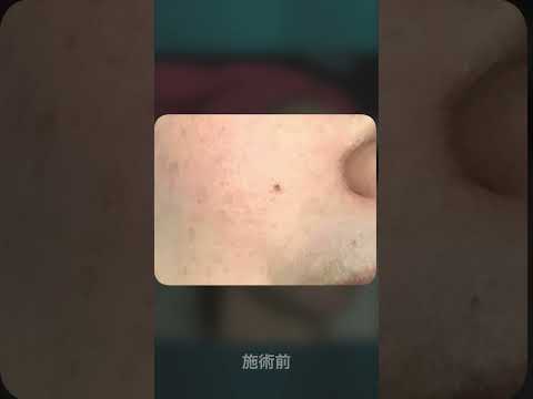 【脱毛・フェイシャル】 当店イチオシの水光ピールのビフォーアフターになります。ぜひ効果を動画で感じてください!#shorts #makeupvideo #beautyface #skincare