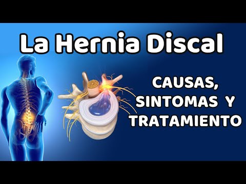LA HERNIA DISCAL, Causas, signos y síntomas, diagnóstico y tratamiento