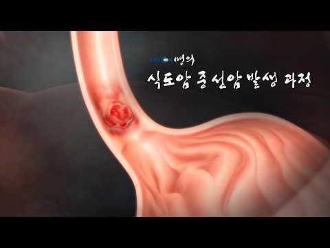 [명의 의학백과📖] 식도암 중 선암 발생 과정