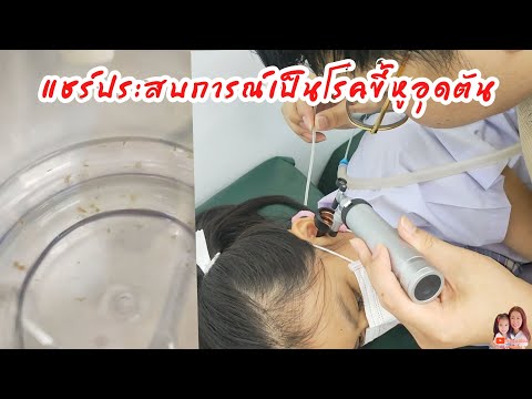 แชร์ประสบการณ์เป็นโรคขี้หูอุดต