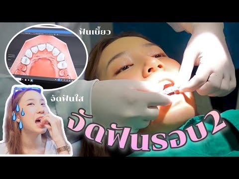 จัดฟันรอบ2-แบบใส!!-แก้ไขฟันหน้ จัดฟันรอบ2-แบบใส!!-แก้ไขฟันหน้