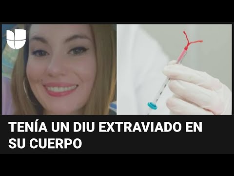 Perdió su dispositivo intrauterino por 12 años y lo hallaron cerca de su colon: ¿qué pasó?