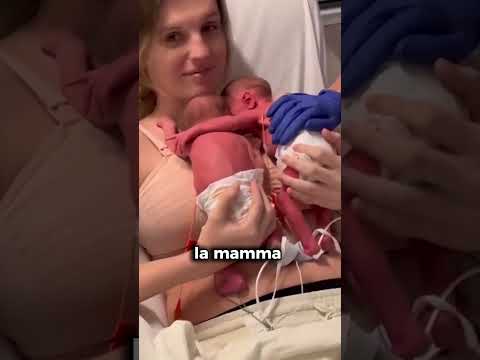 Due gemellini uniti dalla nascita