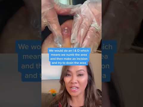 Dr. Pimple Popper Reacts to Inflamed Cyst! #shorts #drpimplepopper