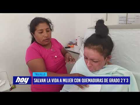 Rioja - San Martín: Salvan la vida a mujer con quemaduras de grado 2 y 3