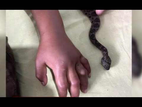 Un niño fue mordido por una serpiente en San Juan Sacatepéquez