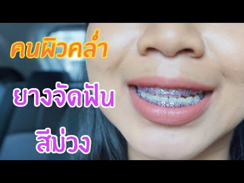 คนผิวคล่ำใส่ยางจัดฟันสีม่วงจะร