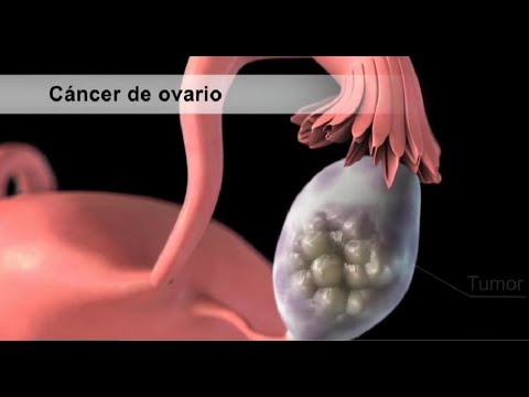 133 mujeres al año padecen de cáncer de ovario en Costa Rica