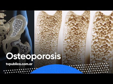 Osteoporosis: qué es y cómo prevenirlo - En Casa Salud