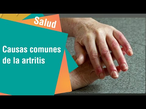 Causas comunes de la artritis | Salud