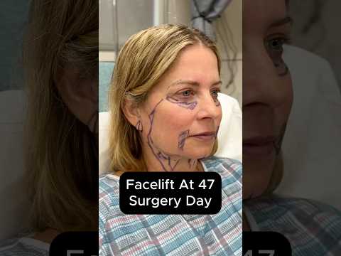 Facelift At 47 - Surgery Day #facelift