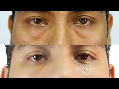 Mirada cansada ? Blefaroplastia inferior  PROMINENTES BOLSAS en los OJOS  Dr Percy Nevado Cirugía