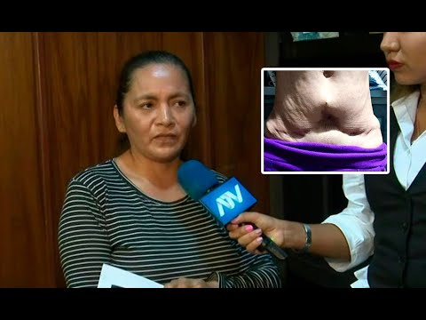Mujer denuncia mala praxis en clínica de San Isidro: Quiso afinar su cintura, pero acabó desfigurada