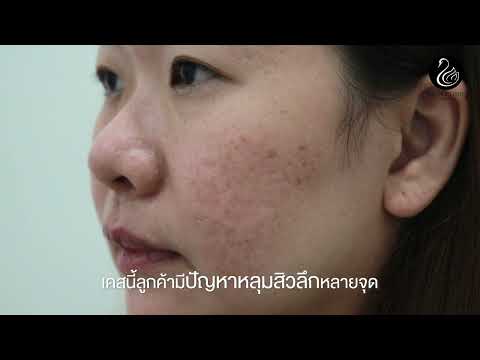 รีวิวรักษาหลุมสิวแบบSubcision