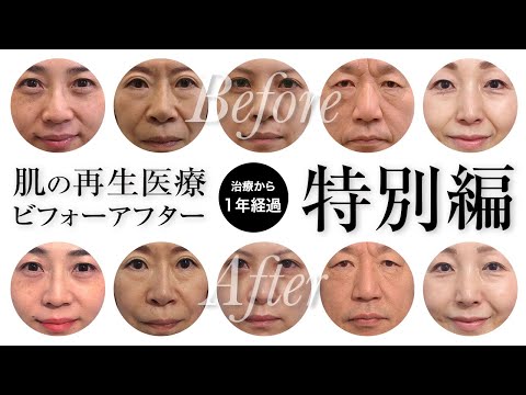 【加工NG】美容治療の効果をリアルに比較する動画｜50代からの顔のたるみエイジングケア治療「肌の再生医療」ビフォーアフター