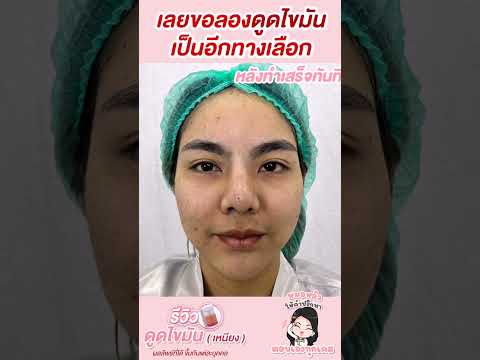 Tonliew Clinic ต้นหลิว คลินิกเวชกรรม มาดูดไขมันเหนียงดีกว่าฉีดสลายไขมันหมดไปหลายขวดไม่ตอบโจทย์สัก