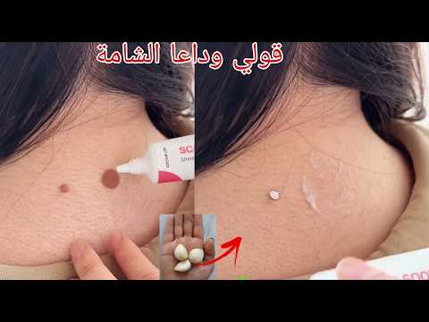 وصفة للقضاء على الشامات وازالتها كأنك أزلتها بعملية دون ترك علامتها قولي وداعا للشامات