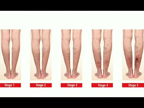 Causas y síntomas de la mala circulación en pies y piernas