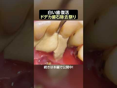 【歯石除去】白い歯復活を願ってドデカ歯石除去祭 #歯石除去 #dentist #ザホワイトデンタルクリニック