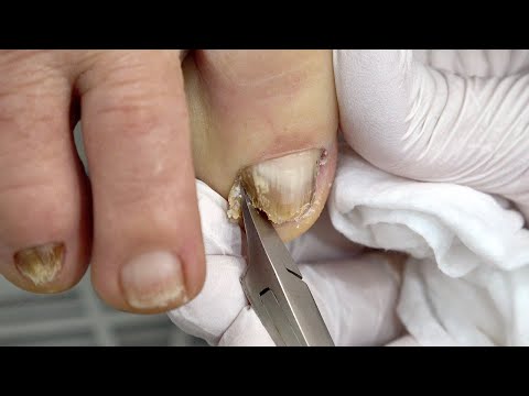 Satisfying Ingrown Toenail Removal Treatment Process Korean Pedicure