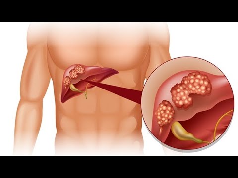 Hepatitis B y C - Cáncer de hígado || SALUD PARA TODOS