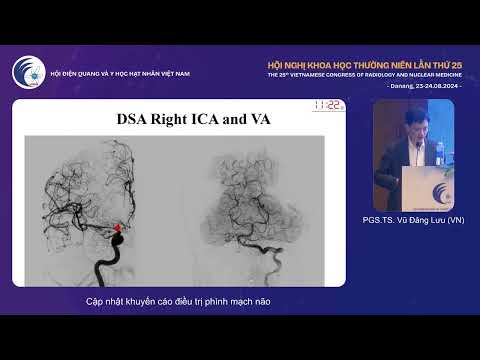 4. Cập nhật khuyến cáo điều trị phình mạch não (PGS.TS. Vũ Đăng Lưu)
