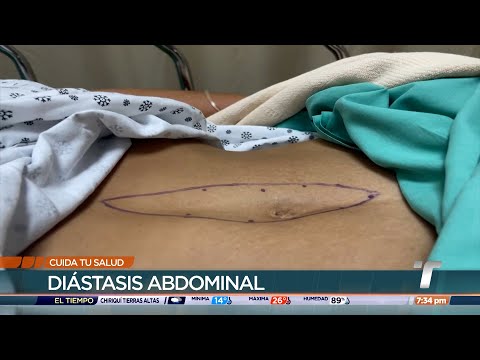 Cuida tu salud: Diástasis abdominal