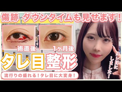 【タレ目整形】可愛くなりたい20代女子のタレ目整形に密着【目尻切開】タレ目/目尻切開のダウンタイムが全てわかる！！【目つき改善】#ZetithBeautyClinic #タレ目おじさん#タレ目