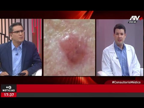 Salud: ¿Cómo prevenir el cáncer a la piel?