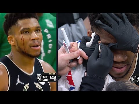 Giannis Gets Nasty Eye Cut As Bucks Defeat Celtics - Doctor Explains