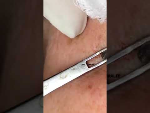 Entfernen einer großen erweiterten Pore | Dr. Pimple Popper #shorts #drpimplepopper