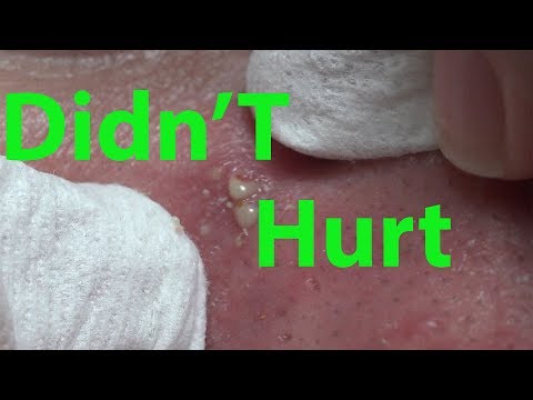Didn't Hurt Except For The Part That Hurt | Life With Cystic Acne Documentary #61