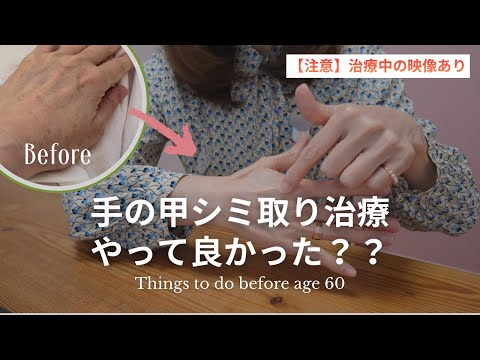 【治療の本音】手の甲のシミ取りレーザーは覚悟が必要!治療前に見てほしいメリットデメリット|治療中の映像にご注意