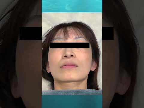 【脱毛・フェイシャル】 当店イチオシの水光ピールのビフォーアフターになります。ぜひ効果を動画で感じてください!#shorts #makeupvideo #beautyface #skincare