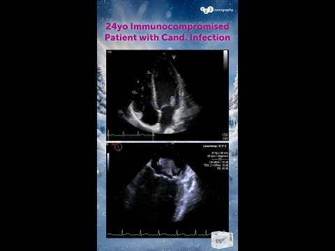 What specific complication of infective endocarditis is observed here? 👀
