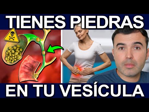 ESTO LLENA TU VESICULA DE PIEDRAS! - Alimentos Y Hábitos Que Producen Cálculos En La Vesícula