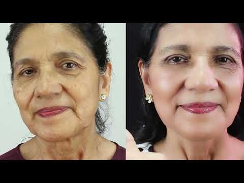 REJUVENECIMIENTO Facial ANTES y DESPUES   MINILIFTING y BLEFAROPLASTIA  Dr Percy Nevado CIRUGÍA