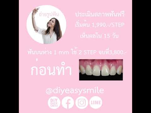 DiyEasy Smile ปรับฟันบน 2 STEP แก้ไขฟันห่าง 2mm ชิดได้ใน 30 วัน