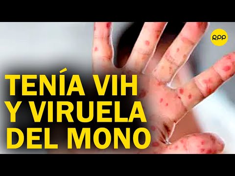 Perú: Un hombre que abandonó tratamiento por VIH falleció con la viruela del mono