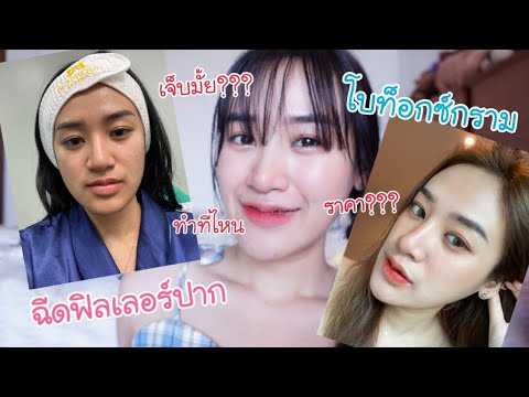 รีวิวฉีดฟิลเลอร์ปาก-ฉีดโบท็อกซ รีวิวฉีดฟิลเลอร์ปาก-ฉีดโบท็อกซ